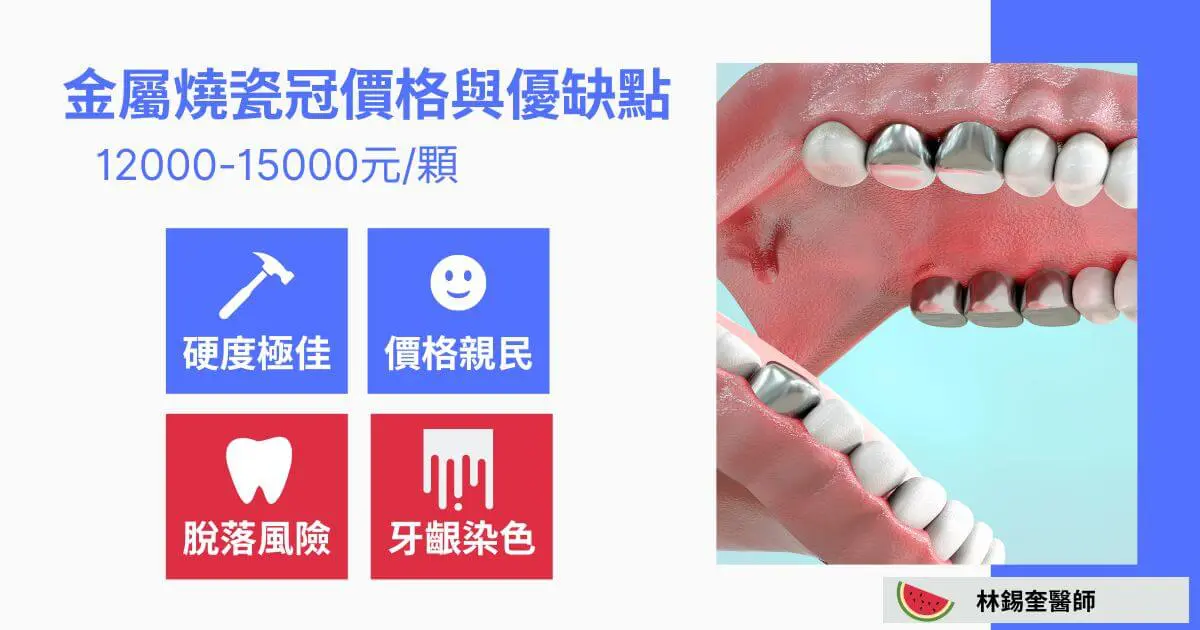 三種牙冠價格比比看,牙冠價格ptt鄉民說「這材質」可用很久 1 金屬瓷牙冠套價格與優缺點