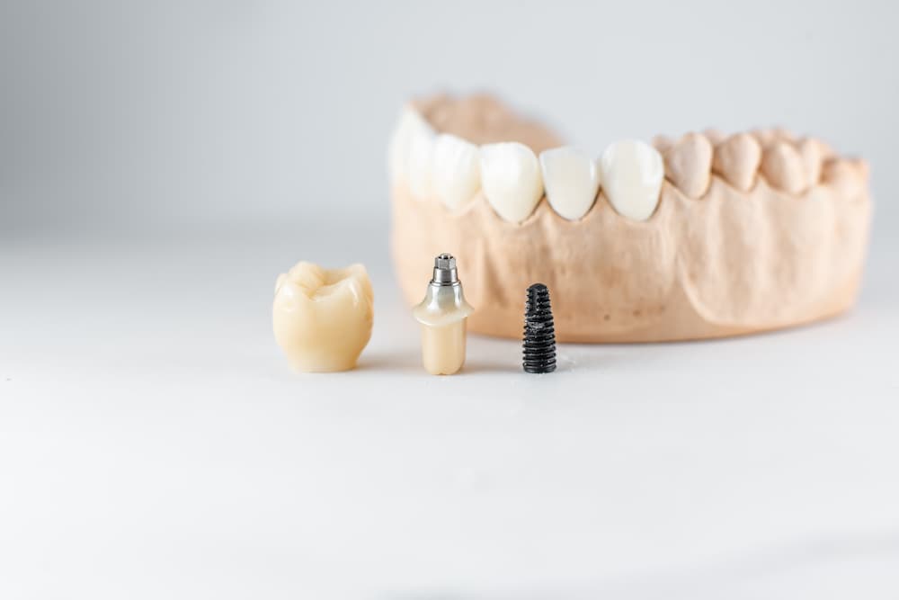 model of artificial jaw and dental implant 2021 09 01 15 20 43 utc 1