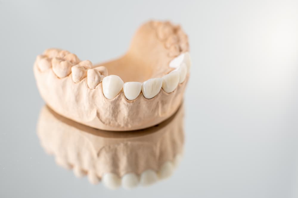 model of artificial jaw with veneers 2021 09 01 14 47 53 utc 2