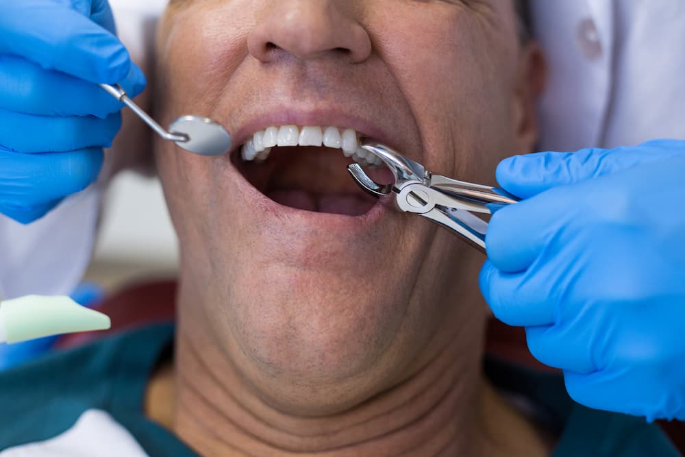 dentist using surgical pliers to remove a decaying P3ZN4F9 1